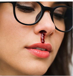 Epistaxe - Jamais coloque a cabeça para trás